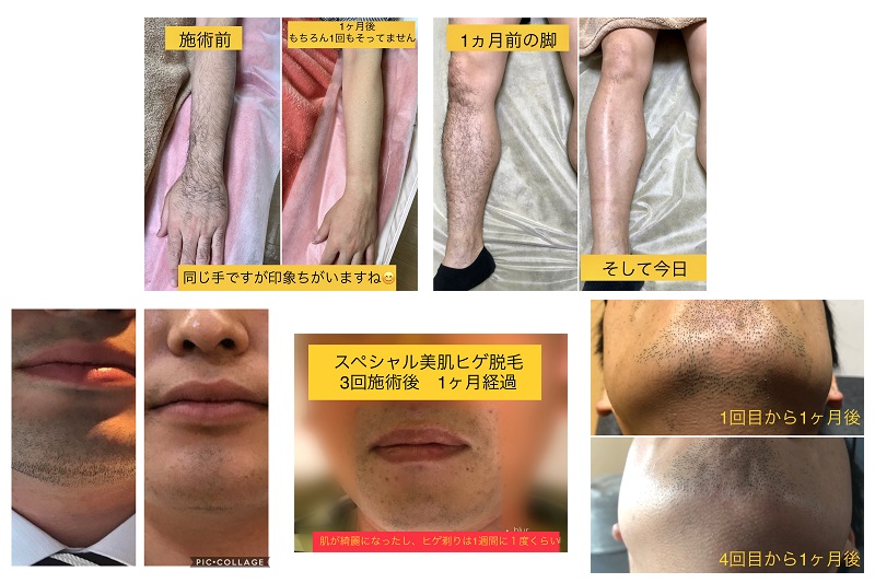 提供：リボーン／施術経過の例
